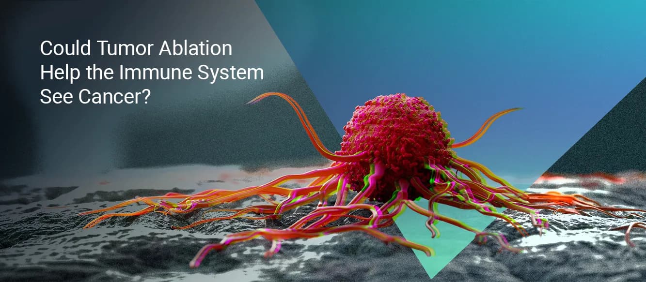 Can Tumor Ablation Help Immunotherapy Work Against Resistant Cancers? Can Tumor Ablation Help Immunotherapy Work Against Resistant Cancers?