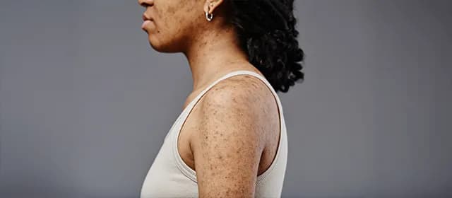 Porokeratosis: A Comprehensive Overview for Healthcare Professionals Porokeratosis: A Comprehensive Overview for Healthcare Professionals